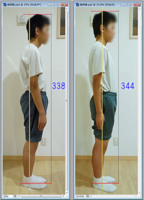 施術前後の身長変化